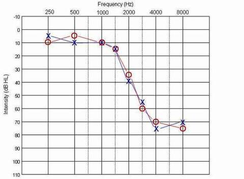 high frequency loss1 large | Οπισθωτιαία Ακουστικά - RIC